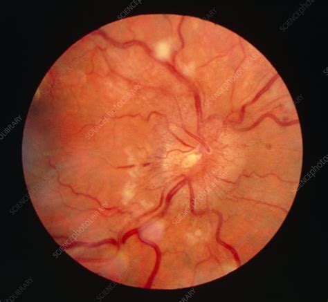 retina hipertansiyonu